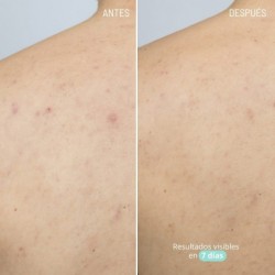 Freshly Cosmetics Trattamento Corpo Attivo Azelaico 100 ml