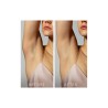 Foreo PEACH 2 IPL Permanent Hair Removal Full Body T-Sonic 1 unit