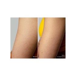 FOREO PEACH 2 GO IPL Compact Hair Removal 1 unit 【OFFER】