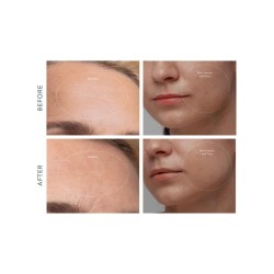 Microdermabrasion avancée FOREO KIWI 1 pièce