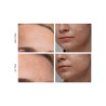 FOREO KIWI Advanced Derma Mikrodermabrasion 1 Stk